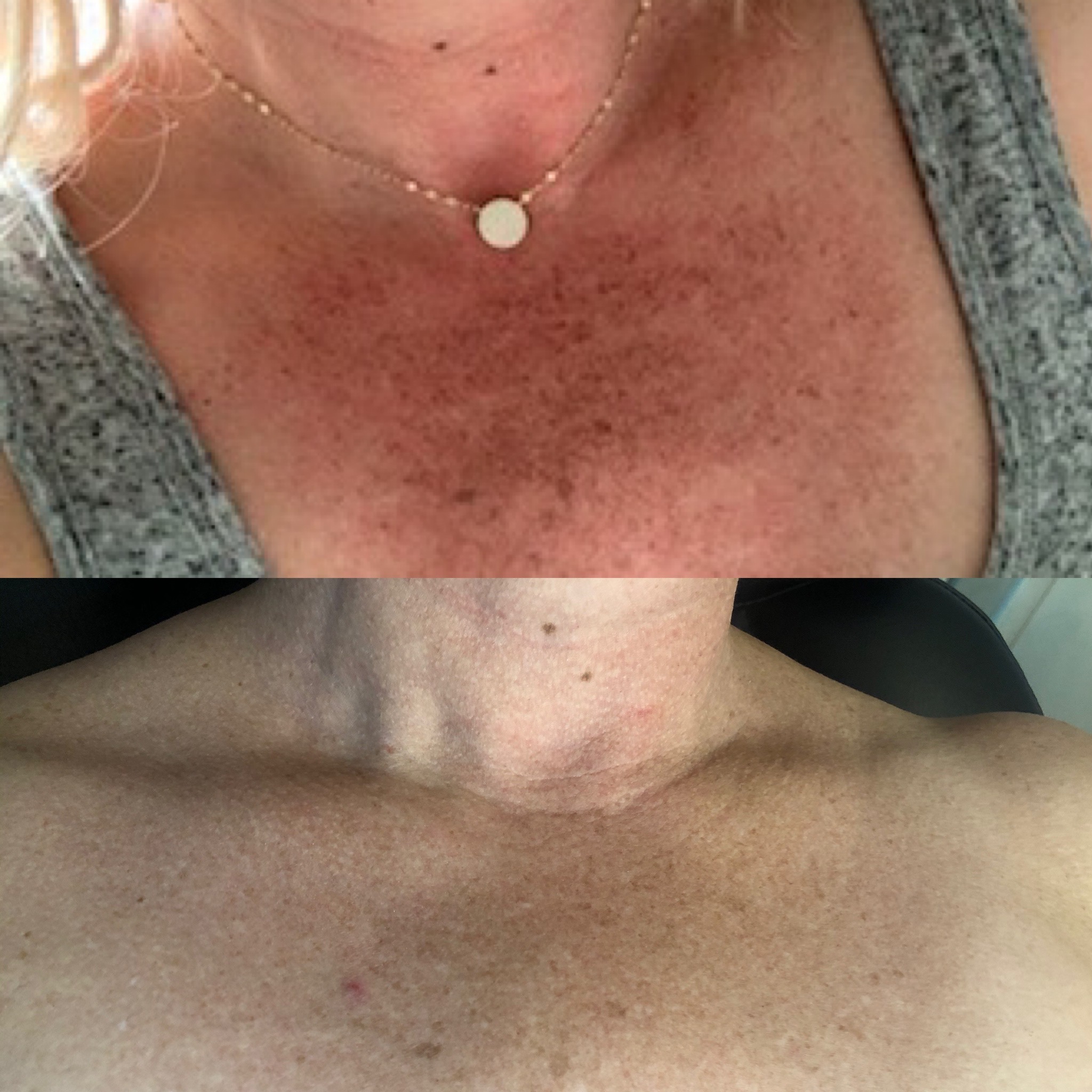 Forever Young_Venus Versa Laser Before After a